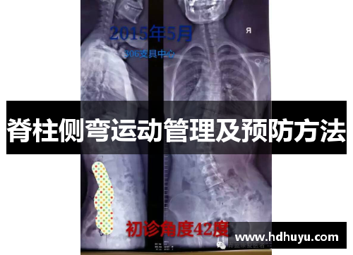 脊柱侧弯运动管理及预防方法